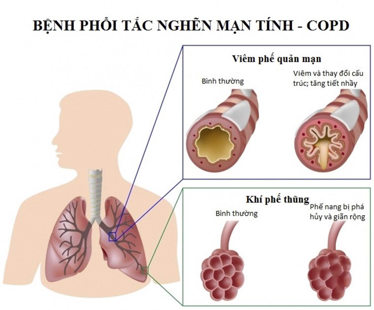 09072019copd1
