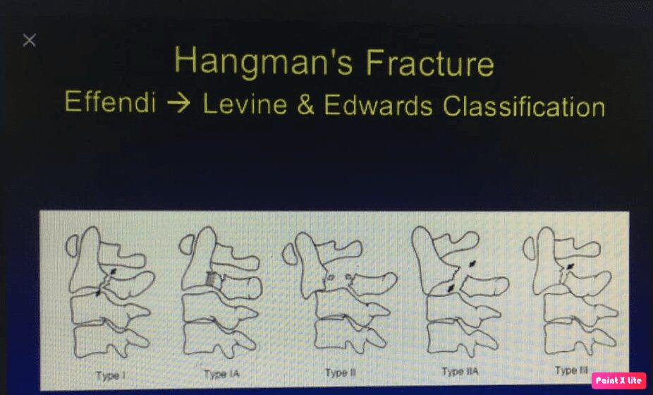 Hangman\'s fracture là chấn thương gì?
