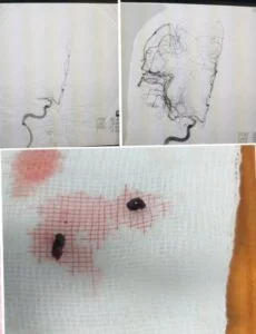Hình ảnh một cục máu đông được lấy ra từ bệnh nhân bị đột quỵ não