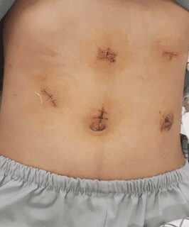 Chấn thương lách trong chấn thương bụng kín 5 Picture10