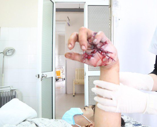 Bàn tay người bệnh sau khi được phẫu thuật bảo tồn