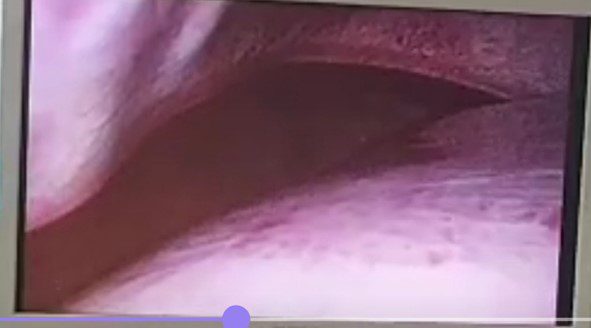 Chấn thương lách trong chấn thương bụng kín 4 Picture9