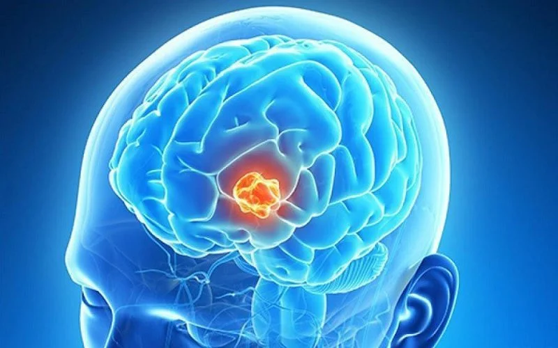 Bài thuốc tự nhiên có thể hỗ trợ điều trị u não không? 
