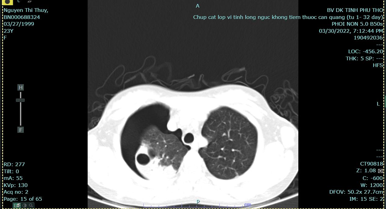 Hình ảnh CT ngực bệnh nhân Nguyễn Thị Thúy 23 tuổi điều trị tại khoa nội HHTH ngày 30.3.2022 có tràn khí màng phổi phải - áp xe phổi - suy tim - suy thận mạn lọc máu chu kỳ