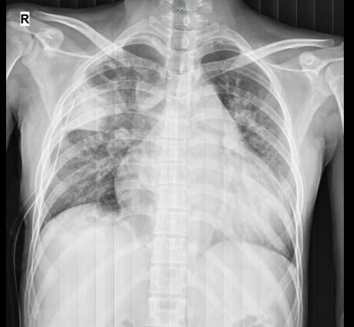 Tràn khí màng phổi - Nguyên nhân và chẩn đoán