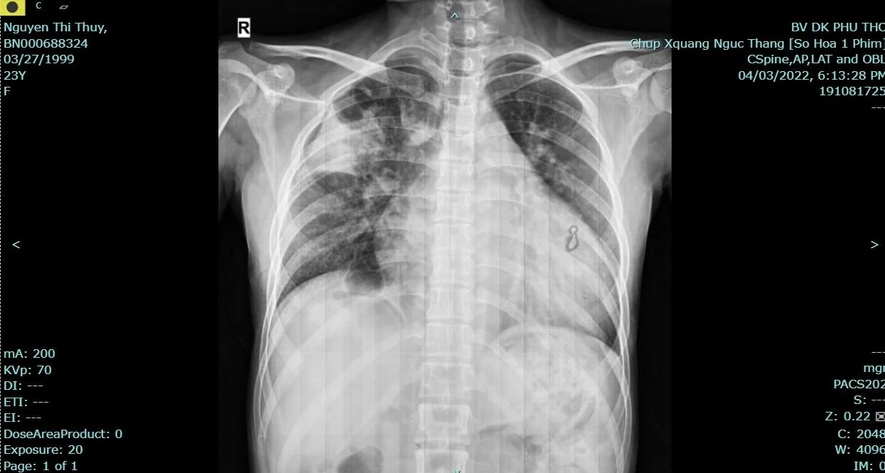 Tràn khí màng phổi - Nguyên nhân và chẩn đoán