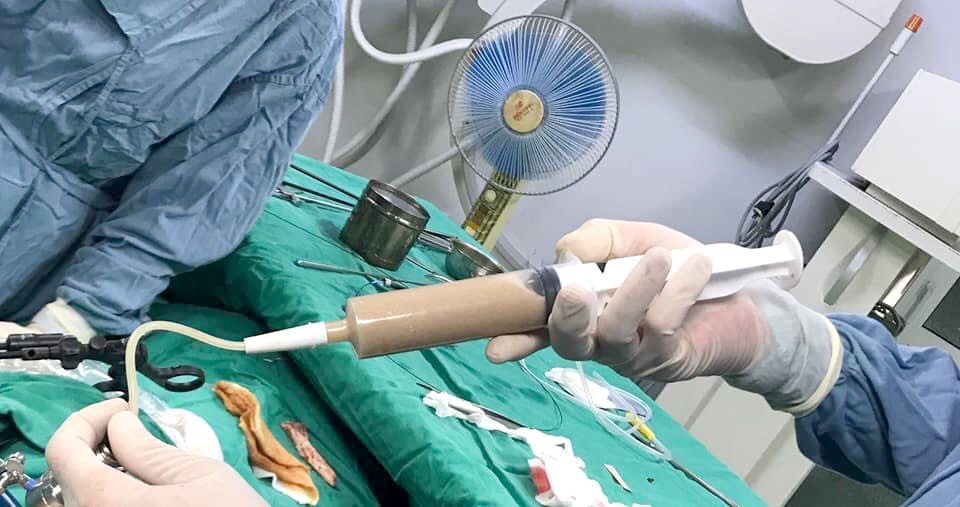 sỏi niệu quản