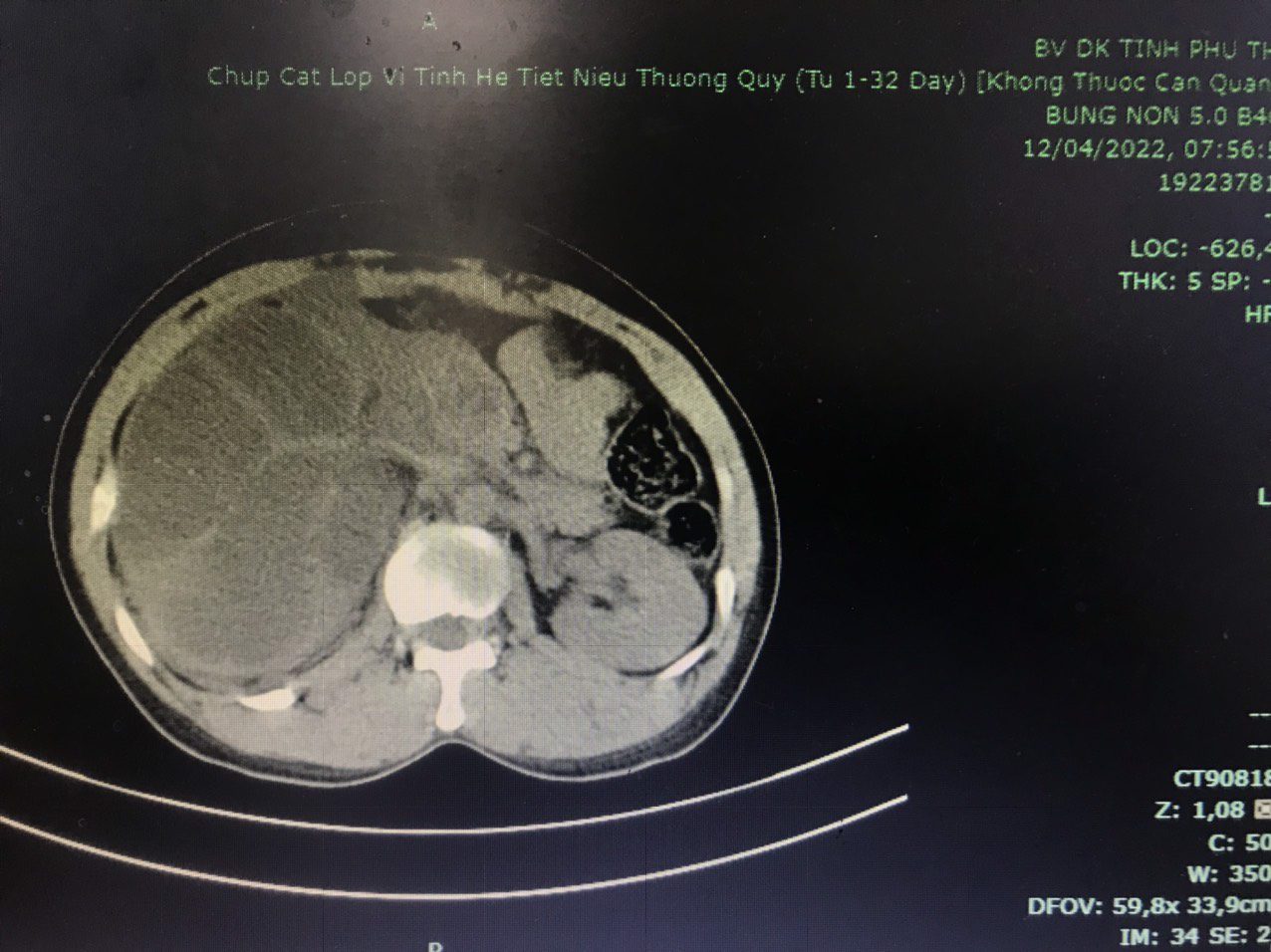 Bệnh nhân sỏi thận 9mm nên tuân thủ chế độ ăn uống và lối sống nào để hạn chế tối đa sự tái phát?
