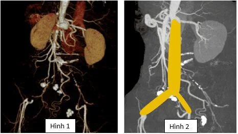 Hình ảnh phim chụp mạch trước mổ: tắc động mạch chủ bụng sát động mạch thận 2 bên lan xuống động mạch chậu, đùi chung 2 bên, có tuần hoàn bàng hệ