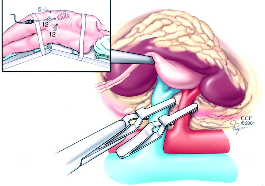 Retroperitoneal laparoscopic partial nephrectomy Because of limited operative space 2