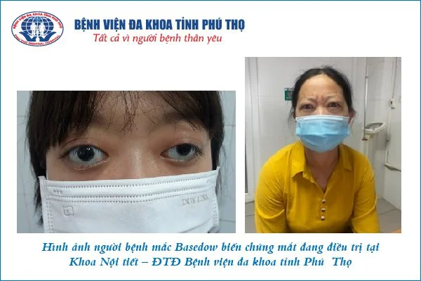 Hình ảnh NB mắc Basedow biến chứng mắt đang điều trị tại khoa      Nội tiết – ĐTĐ Bệnh viện tỉnh Phú  Thọ