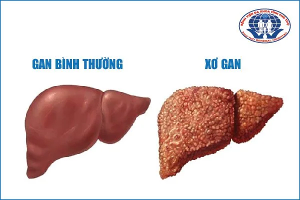 Hình ảnh so sánh giữa gan bình thường và gan bị xơ 