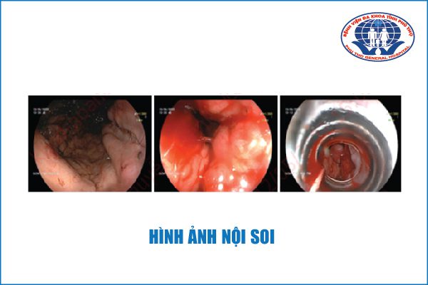 XƠ GAN VÀ 2 ĐIỀU BẠN CẦN BIẾT VỀ BỆNH 3 Hình ảnh nội soi của người bệnh xơ gan