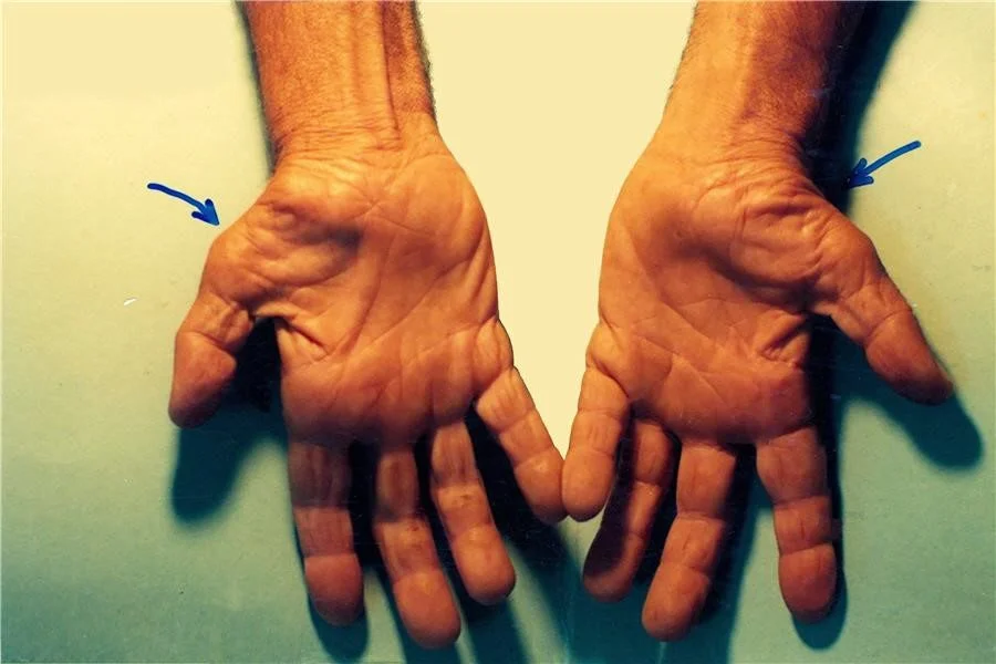 Bàn tay người bệnh mắc hội chứng ống cổ tay