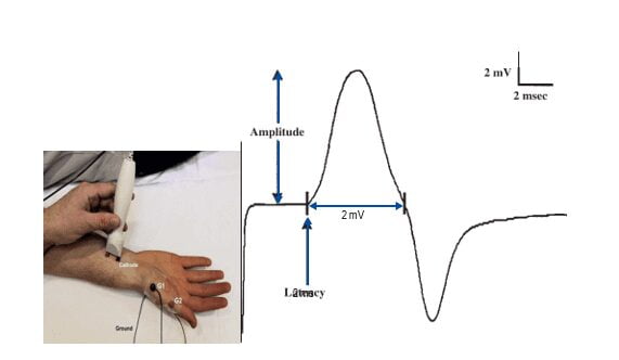 Hình ảnh mô phỏng đo dẫn truyền thần kinh vận động dây thần kinh giữa
