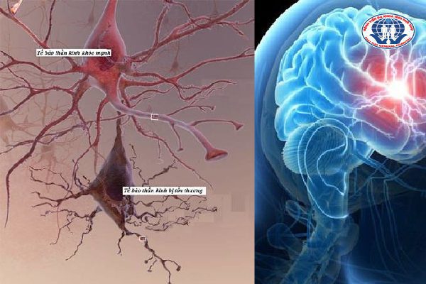  Hình ảnh tế bào thần kinh khỏe mạnh và tế bào thần kinh tổn thương