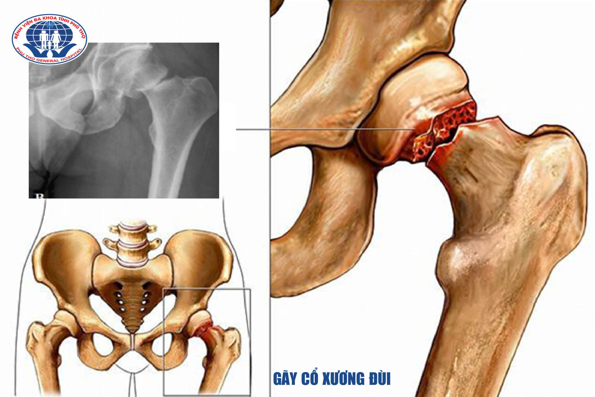 Gãy cổ xương đùi – 4 điều bạn cần biết 1 Hình ảnh gãy cổ xương đùi