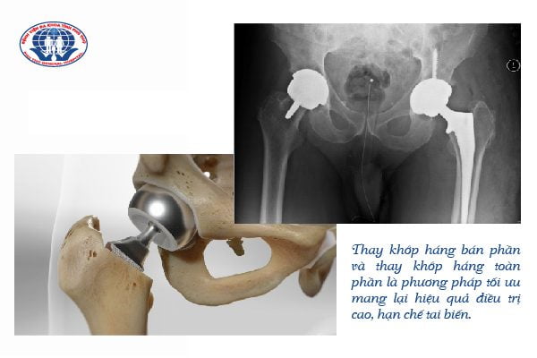 Gãy cổ xương đùi – 4 điều bạn cần biết 2 Thay khớp háng là phương pháp tối ưu nhất hiện nay