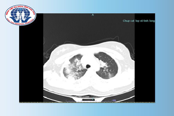 Hình ảnh chụp CT ngực của bệnh nhân khi nhập viện (20/4/2022)