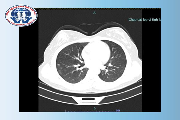 Hình ảnh CT ngực của bệnh nhân sau 12 ngày điều trị (01/5/2022)