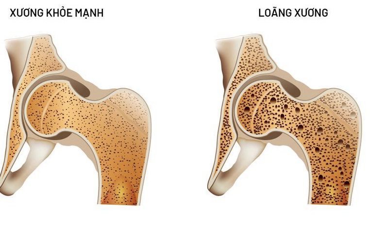 Bệnh loãng xương (Osteoporosis)