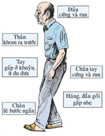 BỆNH PARKINSON Tại Khoa Nội Thần kinh - Cơ xương khớp Bệnh viện đa khoa Tỉnh Phú thọ trong những năm gần đây thu dung và điều trị rất nhiều bệnh nhân mắc bệnh Parkinson. Rất nhiều bệnh nhân đến viện trong tình trạng: điều trị muộn, không điều trị, bỏ điều trị, không tuân thủ thuốc dẫn đến tình trạng loạn động, run giật tăng lên, kháng thuốc, nhiều triệu chứng ngoài vận động rất nặng thậm chí là rối loạn tâm thần. Để hiểu rõ hơn về căn bệnh này, về triệu chứng và phương pháp điều trị cũng như theo dõi,chúng ta cùng tìm hiểu về căn bệnh này. Bệnh Parkinson là một bệnh do thoái hóa hệ thần kinh gây ra, hay có thể nói là bệnh rối loạn thoái hóa tiến triển, là một trong các bệnh lý hay gặp của hệ ngoại tháp, triệu chứng bao gồm rối loạn vận động : chậm chạp, run, cứng đờ, rối loạn thăng bằng. Bệnh do bị mất các tế bào não có khả năng sản sinh dopamin, đó là một chất dẫn truyền thần kinh làm nhiệm vụ dẫn truyền tín hiệu giữa các sợi thần kinh trong một số bộ phận trong não. Đay là bệnh thường gặp ở người cao tuổi, xu hướng mắc bệnh tăng lên do tuổi thọ trung bình tăng lên. Tại Việt Nam, tỷ lệ mắc bệnh Parkinson so với các bệnh thần kinh khác là khoảng 1,6%. 1.	Nguyên nhân và các yếu tố nguy cơ 1.1.	Tuổi và giới Bệnh Parkinson được coi như là bệnh của người cao tuổi. Những thống kê dịch tễ cho thấy tỷ lệ mắc bệnh cao rõ rệt ở những người trên 65 tuổi. Cả nam và nữ đều có thể mắc bệnh Parkinson, tuy nhiên các tác giả đều cho rằng tỷ lệ mắc bệnh ở nam cao hơn nữ. Ở Italia, tỷ lệ mắc bệnh giữa nam/nữ là 1,6. Các nghiên cứu ở Việt Nam cho thấy tỷ lệ mắc bệnh giữa nam/nữ khoảng 1,7. 1.2. Nghề nghiệp và môi trường Mọi đối tượng đều có thể mắc Parkinson, những nghiên cứu gần đây cho thấy một số nghề có nguy cơ mắc bệnh Parkinson cao là: nghề giáo viên, nghề y, nghề hàn, nghề nông, thợ hầm lò, tiếp xúc với kim loại nặng… Đồng thời đã gây được bệnh Parkinson trên thực nghiệm bằng cách tiêm chất MPTP (1methyl 4phenyl 1, 2, 3, 6 tetrahydropiridin) trên khỉ. 1.3. Yếu tố di truyền Những nghiên cứu về mối liên hệ giữa bệnh Parkinson và biến đổi các gen ở người khẳng định rằng di truyền là một yếu tố nguy cơ mắc bệnh. Các gen đã và đang được các tác giả trên thế giới nghiên cứu là gen Alpha synuclein nằm trên nhiễm sắc thể số 4, gen Parkin nằm trên nhiễm sắc thể số 6, gen ApoE nằm trên nhiễm sắc thế số 19 và gen TAU nằm trên nhiễm sắc thể số 17. Một số gen khác được phát hiện gần đây như PARK - 6 nằm trên nhiễm sắc thể số 1, gen Cytochrome P450(CYP2D6)… 1.4. Các yếu tố làm giảm nguy cơ mắc bệnh - Thuốc lá: hút thuốc nói chung và nicotin nói riêng có thể là một yếu tố bảo vệ thần kinh. Trên thực nghiệm nicotin kích thích sự giải phóng dopamine ở thể vân. - Cà phê: cùng với thuốc lá, cà phê cũng được coi như yếu tố bảo vệ trong bệnh Parkinson do cafein làm tăng hoạt tính các thụ cảm thể dopamine. 2. Triệu chứng và chẩn đoán bệnh Parkinson 2.1. Triệu chứng lâm sàng - Ở giai đoạn sớm bệnh Parkinson có thể biểu hiện với các triệu chứng: hay gặp có thể là: mệt mỏi, đau cơ, vụng về khi thực hiện các động tác đơn giản (đi tất, đi giầy, đi dép…), rối loạn chữ viết (micrographia), táo bón, giảm hoạt động một tay khi vận động, vã mồ hôi và bong vảy da ở mặt, gối. Cũng có khi triệu chứng sớm là triệu chứng run khi nghỉ không liên tục, kín đáo. - Đến khi điển hình, bệnh Parkinson biểu hiện bằng 3 triệu chứng cơ bản: + Run: run khi nghỉ, thấy rõ ở ngọn chi, môi, lưỡi. Run thường khu trú ở một bên cơ thể trong nhiều năm đầu, xuất hiện khá sớm, run nhỏ có tần số 4 - 8 chu kỳ/ giây, thường là run ở tư thế nửa nghỉ, khi làm động tác hữu ý không run, run có thể tạm mất nhưng sau đó lại tái diễn, khi ngủ hết run, xúc động tăng run. Run là triệu chứng thường gặp, tuy nhiên có trường hợp hoàn toàn không run. + Cứng đơ (rigidity): là một trong các triệu chứng quan trọng nhất. Cứng đơ lan tràn quá mức thường thấy ở các cơ chống đối với trọng lực, do đó bệnh nhân thường có tư thế nửa gấp, tăng phản xạ tư thế, giai đoạn sau có hiện tượng răng cưa. Triệu chứng căng cứng thường là triệu chứng sớm nhất. + Giảm vận động: mất các động tác tự nhiên của nét mặt, chân, tay, nhất là khi cử động. Mất vẻ biểu lộ tình cảm, nét mặt như người mang mặt nạ, ít chớp mắt, tuy nhiên riêng đôi mắt vẫn còn linh hoạt. Các động tác hữu ý thiếu sự tự nhiên. Giảm vận động là nhóm triệu chứng phức tạp, trong lâm sàng có khi chỉ có triệu chứng này mà không có run và cứng đơ. Trong các triệu chứng cơ bản thì mức độ giảm vận động có liên quan nhiều nhất tới mức độ tổn thương liềm đen, sau đó đến mức độ cứng đơ. Do vậy giảm vận động là triệu chứng có ý nghĩa nhất trong việc theo dõi tác dộng của điều trị, sự tiến triển của tổn thương liềm đen. - Các triệu chứng khác: + Rối loạn cảm giác: thường có loạn cảm đau, đứng ngồi không yên, nóng bức. + Rối loạn phản xạ: phản xạ gân xương, phản xạ mũi mi nhạy, có thể thấy các phản xạ trục như gan tay- cằm, phản xạ vòi, không có phản xạ bệnh lý bó tháp. + Rối loạn thần kinh thực vật: hay gặp là tăng tiết, phù, tím tái ngọn chi, rối loạn chức năng dạ dày, rối loạn cương, rối loạn bàng quang cấp, hạ huyết áp tư thế. + Rối loạn tâm thần: có triệu chứng trầm cảm, một số ít có thể có ảo thị, trí tuệ còn tốt, có thể gặp sa sút trí tuệ ở giai đoạn nặng. - Đặc điểm lâm sàng ở bệnh nhân khởi phát bệnh sớm và có yếu tố di truyền: triệu chứng lâm sàng ở những bệnh nhân mắc Parkinson khởi phát bệnh khi còn trẻ (trước 45 tuổi) và những người có yếu tố gia đình so với những bệnh nhân Parkinson thông thường có một số điểm khác biệt chú ý: + Những bệnh nhân này đáp ứng tốt với liệu pháp dopamine, ít có sa sút trí tuệ (dementia) và thường có loạn vận động do L - dopa sớm hơn so với bệnh nhân cao tuổi. + Ở bệnh nhân xuất hiện đột biến gen alpha synuclein ít thấy triệu chứng run khi nghỉ, hay gặp giảm vận động và cứng đơ. 2.2. Các xét nghiệm cận lâm sàng 2.2.1. Xét nghiệm máu, dịch não tuỷ Các xét nghiệm thông thường đều trong giới hạn bình thường, trong một số trường hợp nó giúp cho chẩn đoán phân biệt hội chứng Parkinson do các nguyên nhân khác nhau. 2.2.2. Các phương pháp chẩn đoán hình ảnh - Chụp cắt lớp vi tính: có thể thấy hình ảnh teo não, vôi hoá ở não, giãn các não thất nhưng không có giá trị quyết định đối với bệnh Parkinson. Phương pháp này chỉ giúp chẩn đoán các nguyên nhân gây hội chứng Parkinson. - Chụp cộng hưởng từ: có thể thấy hình ảnh teo phần đặc của liềm đen, thu hẹp chất đen ở thân não, trên ảnh T2 thấy liềm đen giảm cường độ tín hiệu so với nhóm chứng. Ngoài ra chụp cộng hưởng từ cũng phát hiện được các nguyên nhân gây hội chứng Parkinson thứ phát. - Chụp cắt lớp vi tính với điện tử dương (position emistion tomography: PET): dùng các chất đánh dấu phát xạ để đánh giá tình trạng các tế bào thần kinh sản xuất dopamine ở liềm đen hoặc đánh giá tình trạng các thụ thể dopamine ở thể vân. - Chụp cắt lớp vi tính đơn photon (single position emision computer tomography: SPECT): phương pháp này sử dụng các chất đánh dấu đánh giá sự hấp thu phóng xạ của các hạch nền não. Chụp cắt lớp vi tính với điện tử dương và chụp cắt lớp vi tính đơn photon có thể xác định bệnh Parkinson giai đoạn sớm (tiền lâm sàng) và chẩn đoán phân biệt hội chứng Parkinson do các nguyên nhân khác. 2.3. Chẩn đoán 2.3.1. Chẩn đoán xác định Chẩn đoán xác định bệnh có thể tuân thủ theo các bước như sau: - Có thể là bệnh Parkinson nếu có một trong các triệu chứng run lúc nghỉ hoặc ở một tư thế, cứng đơ, giảm vận động. - Nhiều khả năng là bệnh Parkinson nếu có hai trong các triệu chứng run lúc nghỉ, cứng đơ, giảm vận động, tư thế bất an. - Chẩn đoán chắc chắn bệnh Parkinson nếu có cả 3 triệu chứng chính hoặc 2 triệu chứng với triệu chứng không đối xứng, loại trừ các nguyên nhân gây hội chứng Parkinson thứ phát hoặc run lúc nghỉ, triệu chứng không đối xứng, đáp ứng tốt với L - dopa. 2.3.2. Chẩn đoán giai đoạn của bệnh Parkinson - Giai đoạn 1: Có các dấu hiệu ở 1 bên cơ thể, bệnh nhân vẫn tự chủ trong các sinh hoạt. - Giai đoạn 2: có các dấu hiệu ở hai bên nhưng không bị mất thăng bằng. - Giai đoạn 3: có triệu chứng cả 2 bên cơ thể có mất thăng bằng nhưng bệnh nhân vẫn tự chủ được trong hoạt động tuy có bị hạn chế. - Giai đoạn 4: bị suy giảm chức năng nặng nhưng vẫn có thể đi đứng được cần sự hỗ trợ một phần. - Giai đoạn 5: bệnh nhân phải ngồi xe lăn hoặc nằm tại giường, không còn tự chủ được                                                                        Hình: Dáng người bệnh nhân Parkinson 2.3.3. Chẩn đoán phân biệt - Run tuổi già - Run nguyên phát (run gia đình - essential tremor - Hội chứng Parkinson do thuốc an thần - Hội chứng Parkinson căn nguyên mạch máu 3. Điều trị bệnh Parkinson 3.1. Nguyên tắc điều trị bệnh Parkinson - Bệnh Parkinson là bệnh tiến triển mạn tính nên phải điều trị lâu dài. - Ở bệnh nhân mới mắc nên sử dụng nhóm kháng cholin, amantadin, selegilin, thuốc đồng vận với dopamine. Trì hoãn dùng L - dopa càng dài càng tốt. - Dùng đơn trị liệu, liều thấp tăng dần, duy trì ở liều tác dụng. - Ưu tiên hàng đầu là điều trị nội khoa. - Phẫu thuật chỉ nên sử dụng khi bệnh nhân không đáp ứng với các thuốc hoặc để làm nhóm đối chứng trong nghiên cứu. 3.2. Các nhóm thuốc điều trị bệnh Parkinson - Nhóm Alcaloide. - Các thuốc kháng histamin tổng hợp. - Nhóm thuốc kháng cholin tổng hợp. Cơ chế tác động là ức chế hoạt động của hệ cholin ở hệ thần kinh trung ương. Các chất này qua được hàng rào máu não nên có tác dụng tốt trong điều trị và hạn chế được các tác dụng ngoại vi. - Nhóm thuốc có tác dụng đồng vận với dopamine (dopamine agonist). Các chất đồng vận dopamine tác động theo cơ chế kích thích trực tiếp các thụ thể dopamine ở màng sau khớp thần kinh (xinap). Tác dụng phụ của nhóm đồng vận dopamine thấy trên tim mạch và tiêu hoá: hạ huyết áp, đau bụng, buồn nôn… - Các thuốc thay thế dopamine (levo dopa = L - dopa): ưu điểm của L-dopa là bổ sung dopamine kịp thời và đúng cơ chế bệnh sinh. Để khắc phục tác dụng phụ, hiện nay người ta dùng L - dopa dưới dạng kết hợp với chất ức chế men khử carbon là madopar và sinemet. Tuy nhiên, việc cho chỉ định dùng L - dopa để điều trị cần phải cân nhắc kỹ (tuỳ theo lứa tuổi, tuỳ theo giai đoạn của bệnh....) và trì hoãn càng lâu càng tốt vì hiện tượng loạn động do dopamine và những khó khăn trong việc điều trị bệnh. - Các thuốc ức chế quá trình dị hoá dopamine: thuốc ức chế men oxy hoá amin đơn (selegilin) và các thuốc ức chế men COM (đại diện là tolcapon). 3.3. Các phương pháp điều trị khác - Trong điều trị bệnh Parkinson, lựa chọn đầu tiên là điều trị bằng thuốc, các phương pháp khác chỉ sử dụng khi điều trị nội khoa ít kết quả. Gồm có các phương pháp sau: Phẫu thuật, kích thích não ở sâu, xạ phẫu... - Các phương pháp điều trị phẫu thuật: làm tổn thương, phá huỷ cấu trúc vùng đích dẫn đến thay đổi chức năng. -  Điều trị bằng phục hồi chức năng, y học cổ truyền: tác dụng hạn chế, chưa có công bố các nghiên cứu. Hiện nay tại Khoa Nội Thần kinh- Cơ xương khớp Bệnh viện đa khoa tỉnh Phú Thọ đang áp dụng các biện pháp điều trị nội khoa bằng các thuốc đặc hiệu cho bệnh lý Parkinson đem lại hiệu quả rõ rệt nhằm nâng cao chất lượng cuộc sống cho người bệnh , giảm bớt nguy cơ tàn phế cho người bệnh. Người bệnh khi mắc bệnh Parkinson hoặc có triệu chứng nghi ngờ bệnh Parkinson hãy liên hệ để được tư vấn điều trị: Khoa Nội Thần kinh- Cơ xương khớp , Bệnh viện đa khoa tỉnh Phú thọ: 0210.6254.067 Tiến sỹ - Bác sỹ Lê Thị Bích Thủy : 0983.200.845