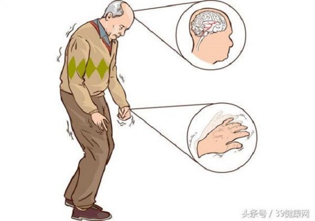 Điều gì xảy ra với cơ thể khi bệnh Parkinson phát triển nặng hơn và tiến triển ngay sau khi chẩn đoán?