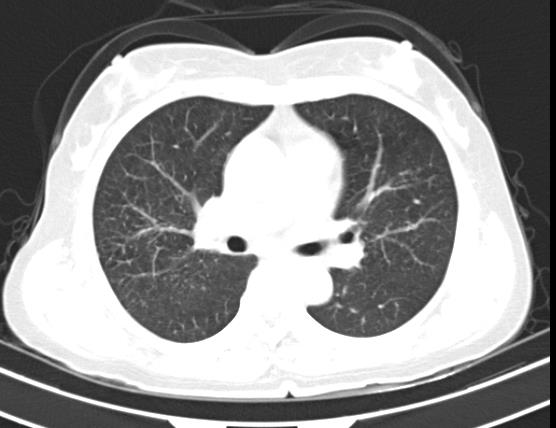 BỆNH SARCOIDOSIS