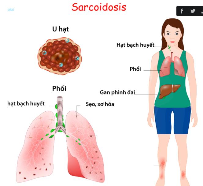 16062022 SARCOIDOSIS 3