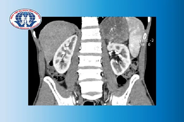Người bệnh nam 49 tuổi, vào khoa Nội tiết với chẩn đoán u thượng thận trái phát hiện tình cờ kích thước 87x67 mm. Sau khi được thăm khám và làm các xét nghiệm chẩn đoán Ung thư phổi phải di căn tuyến thượng thận.