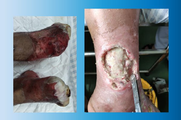 BIẾN CHỨNG BÀN CHÂN Ở NGƯỜI BỆNH ĐÁI THÁO ĐƯỜNG – 5 ĐIỀU CẦN BIẾT ĐỂ TRÁNH HẬU QUẢ 2 Biến chứng bàn chân ở người bệnh đái tháo đường, người bệnh cần đến ngay cơ sở y tế để điều trị kịp thời tránh hậu quả nặng nề