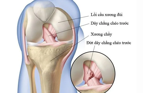 PHẪU THUẬT NỘI SOI TÁI TẠO DÂY CHẰNG CHÉO TRƯỚC KHỚP GỐI