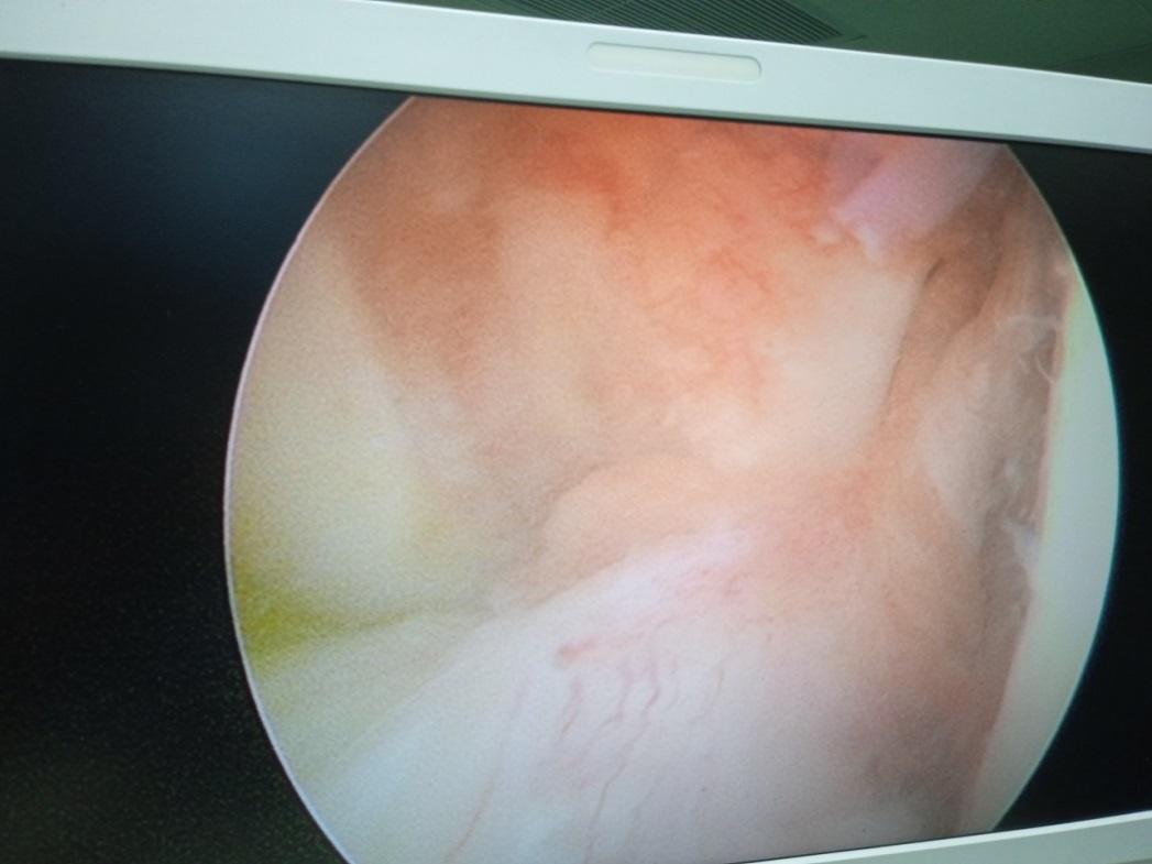 Hình ảnh dây chằng chéo trước bệnh nhân bị đứt tại vị trí điểm bám lồi cầu ngoài đùi trái