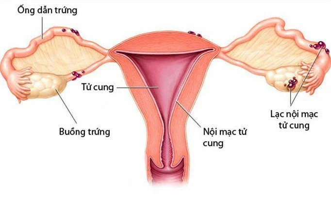 Hình ảnh lạc nội mạc tử cung ở thành bụng