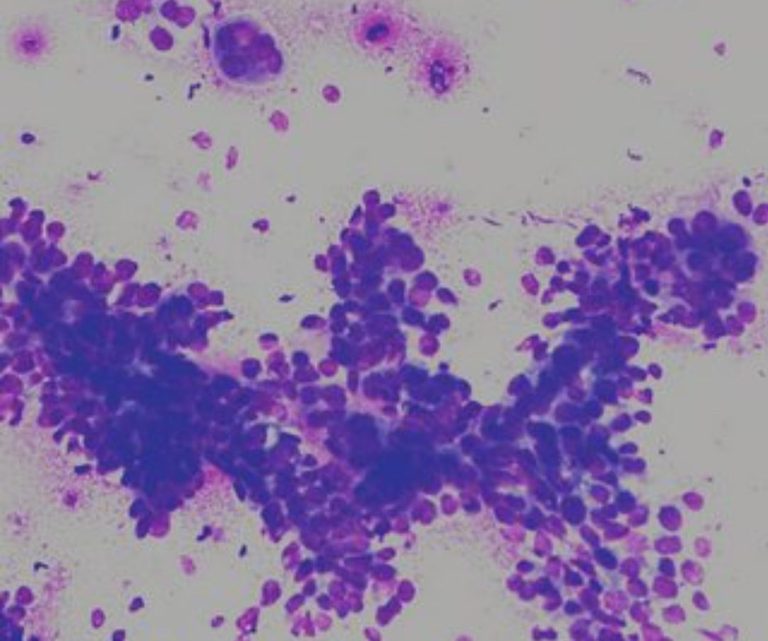 Hình ảnh tế bào lạc nội mạc tử cung trên tiêu bản xét nghiệm