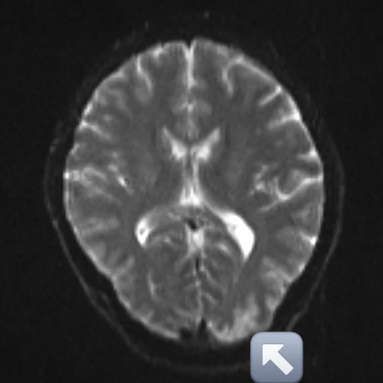Tổn thương trên MRI sọ não của người bệnh mắc hội chứng bệnh não sau có hồi phục