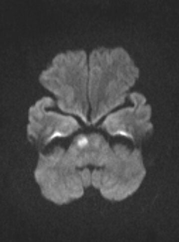 Hình ảnh Cộng hưởng từ sọ não (MRI) người phụ nữ bị ong đốt: Với xung khuếch tán Diffusion cho kết quả nhồi máu cầu não phải 