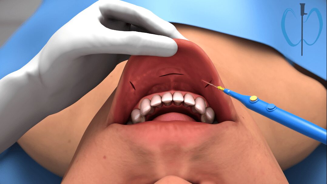 Phẫu thuật tuyến giáp qua đường miệng được thực hiện như thế nào
