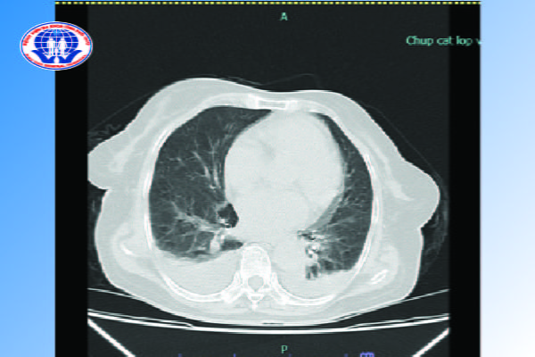 Hình ảnh cắt lớp vi tính lồng ngực của người bệnh sốt mò