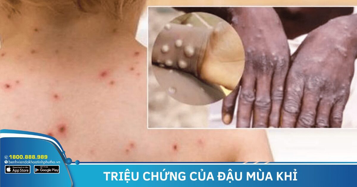 TRIỆU CHỨNG CỦA ĐẬU MÙA KHỈ