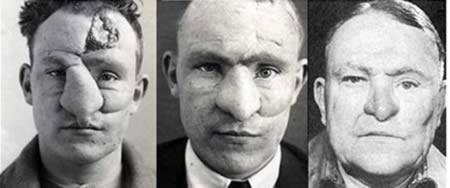 a98767 first plastics 2 nosejob