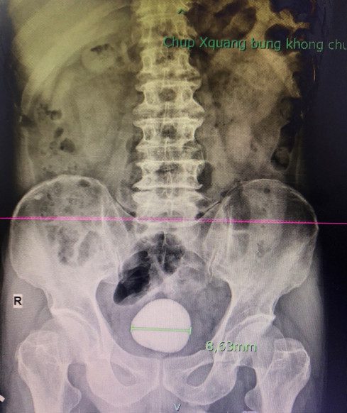 Ảnh 2: Hình ảnh chụp Xquang của Người bệnh có viên sỏi bàng quang