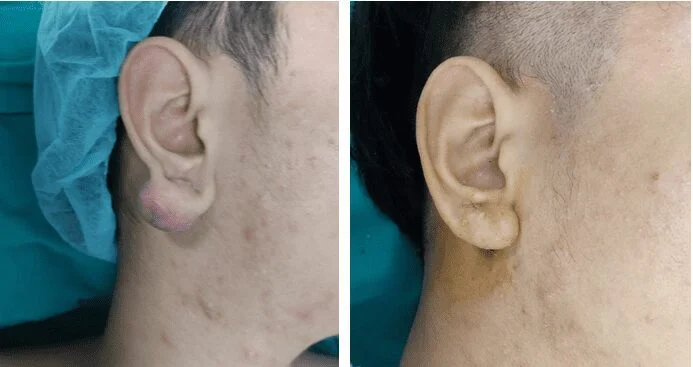 Sẹo lồi vùng dái tai phải trước và sau điều trị