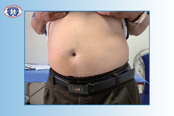 Hình ảnh một bệnh nhân béo phì đến khám tại khoa Nội tiết - Đái tháo đường – Bệnh viện Đa khoa tỉnh Phú Thọ