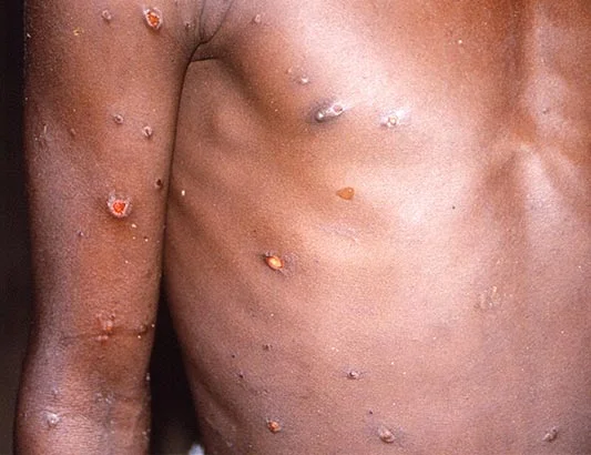 Cánh tay và ngực của một người bị tổn thương da do đậu mùa khỉ