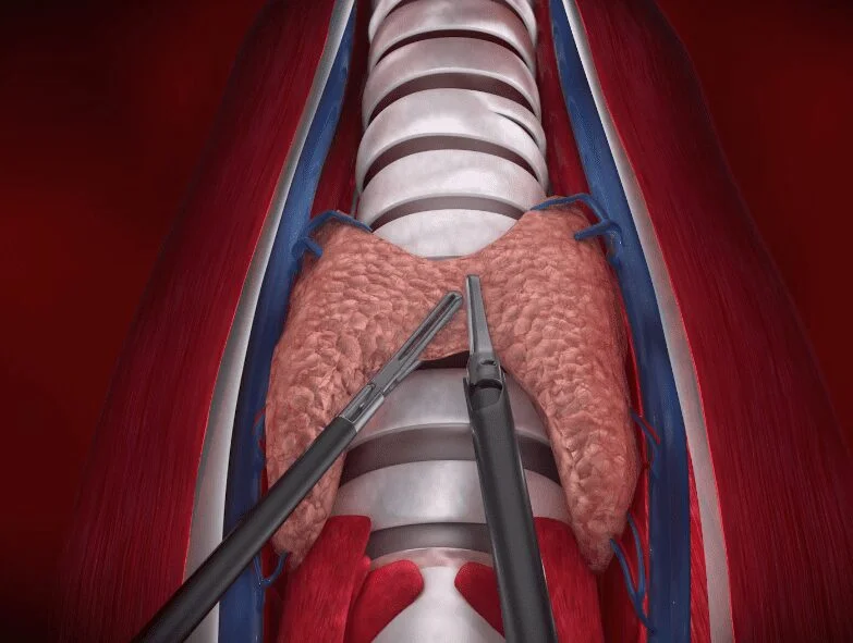 phẫu trường của mổ tuyến giáp nội soi qua đường miệng