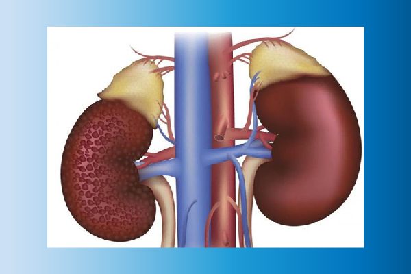 BIẾN CHỨNG THẬN DO ĐÁI THÁO ĐƯỜNG – 6 ĐIỀU NGƯỜI BỆNH PHẢI CHÚ Ý 1 Biến chứng thận do đái tháo đường tại Bệnh viện đa khoa tỉnh Phú Thọ có tỷ lệ tương đối cao