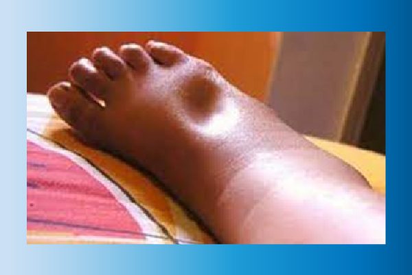 BIẾN CHỨNG THẬN DO ĐÁI THÁO ĐƯỜNG – 6 ĐIỀU NGƯỜI BỆNH PHẢI CHÚ Ý 3 Biến chứng thận do đái tháo đường trong đó có triệu chứng phù bàn chân