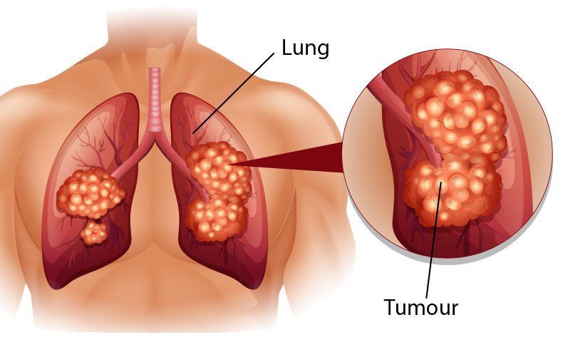 Ung thư phổi – đơn giản hay phức tạp?