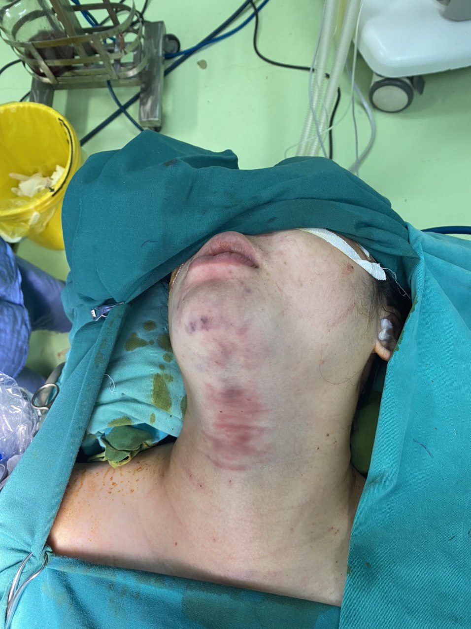 Hình ảnh người bệnh ngay sau phẫu thuật nội soi tuyến giáp qua đường miệng không hề để lại sẹo